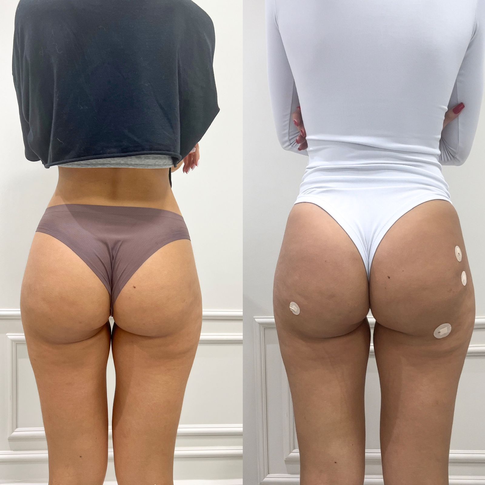 Remodelação Glútea