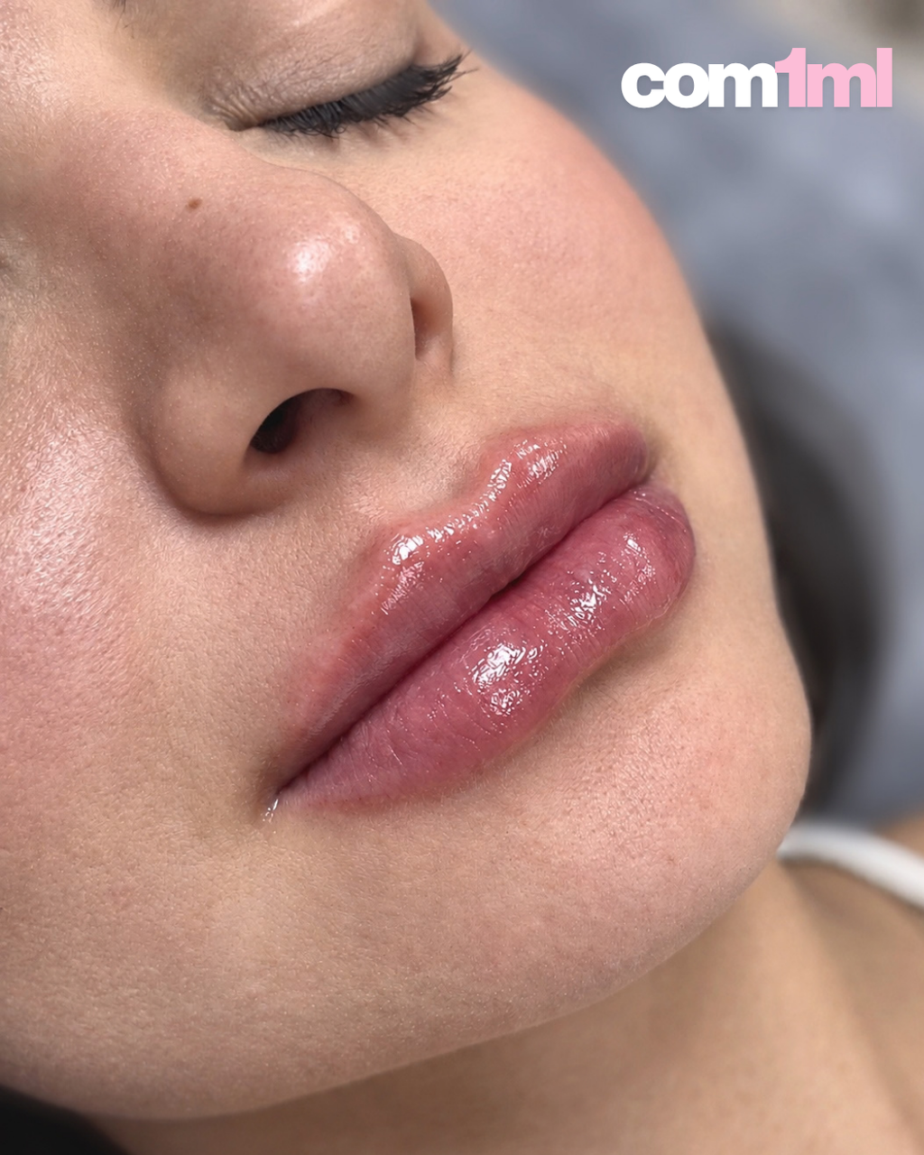 Preenchimento Labial Restylane Classic com Anestesia