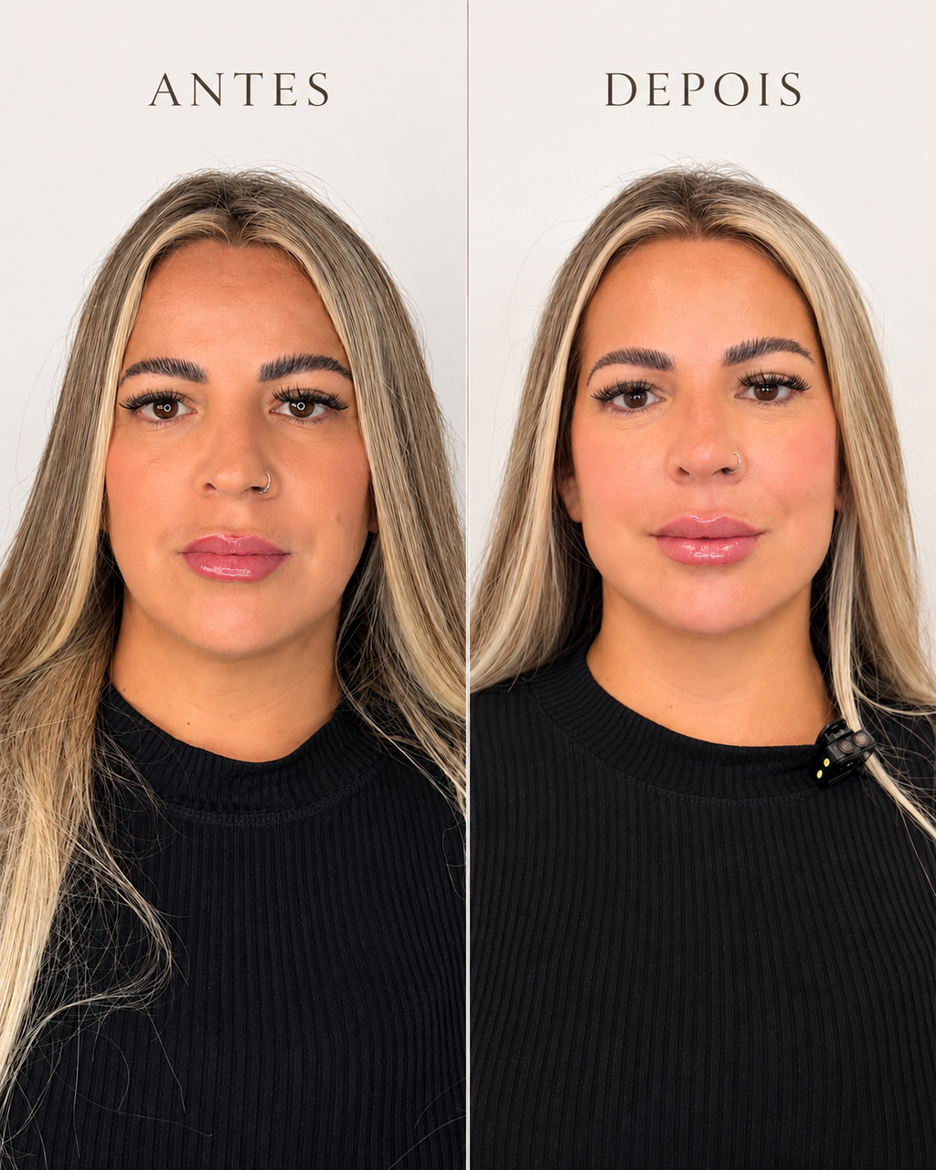 Harmonização Facial Rennova 10 ml com Anestesia