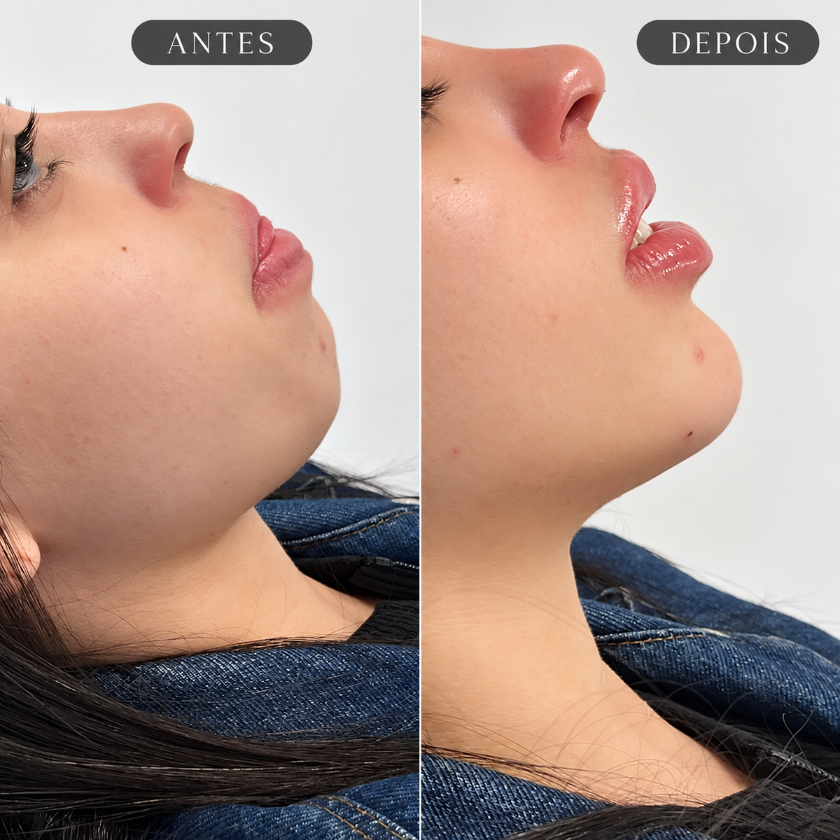Preenchimento de Mento Restylane Shaype com Anestesia