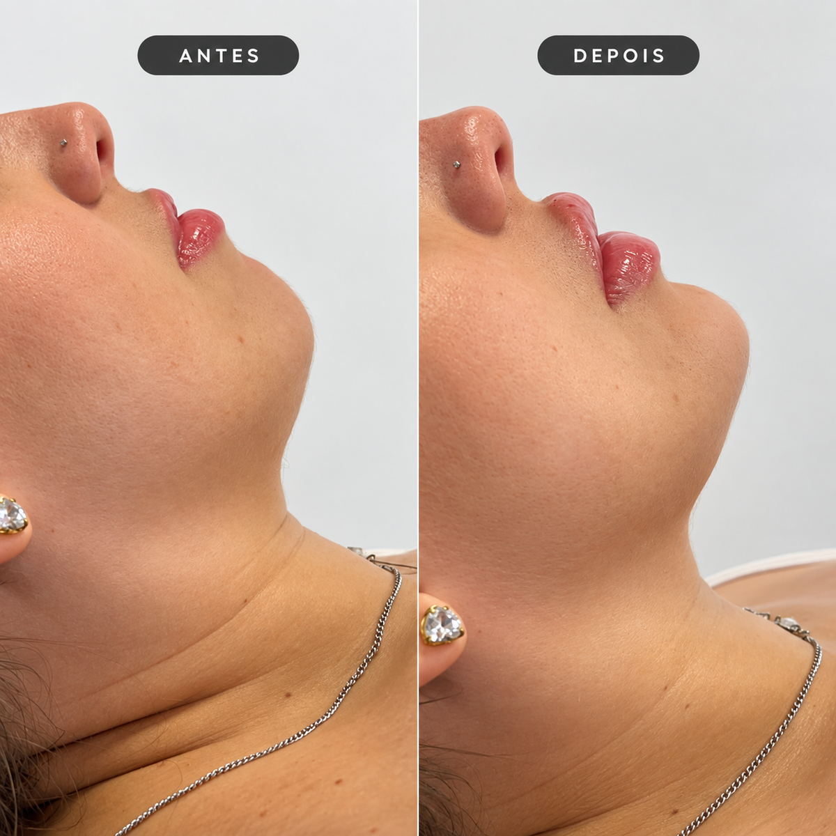 Perfiloplastia MAP 3 com Ácido Hialurônico sem Cirurgia