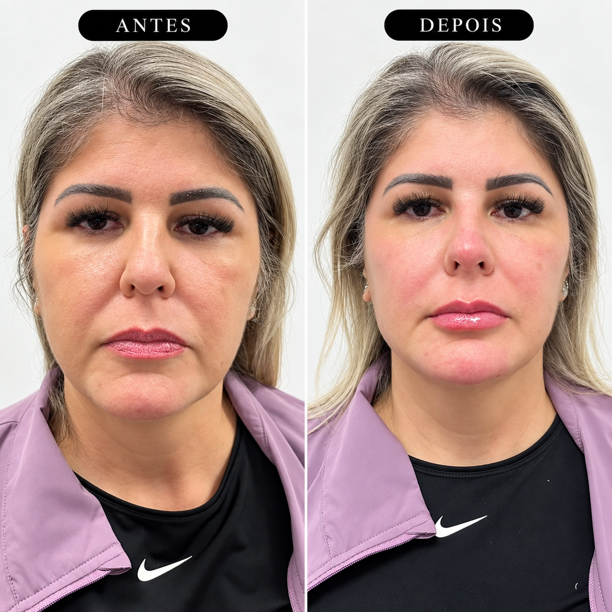 Preenchimento Malar Restylane Volyme com Anestesia