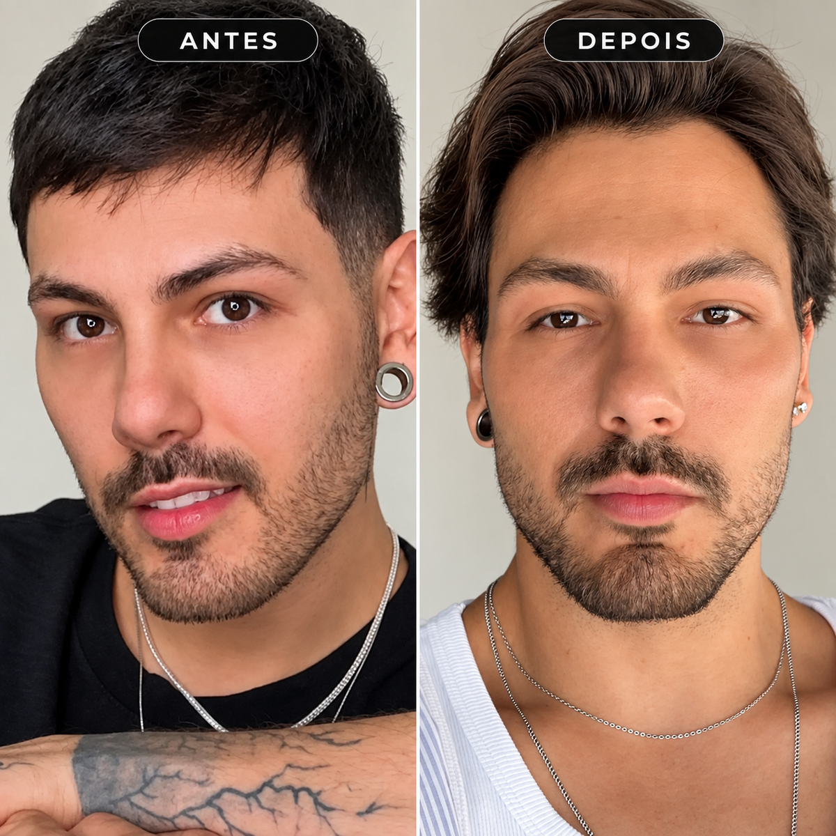 Preenchimento de Mandíbula Restylane Defyne com Anestesia