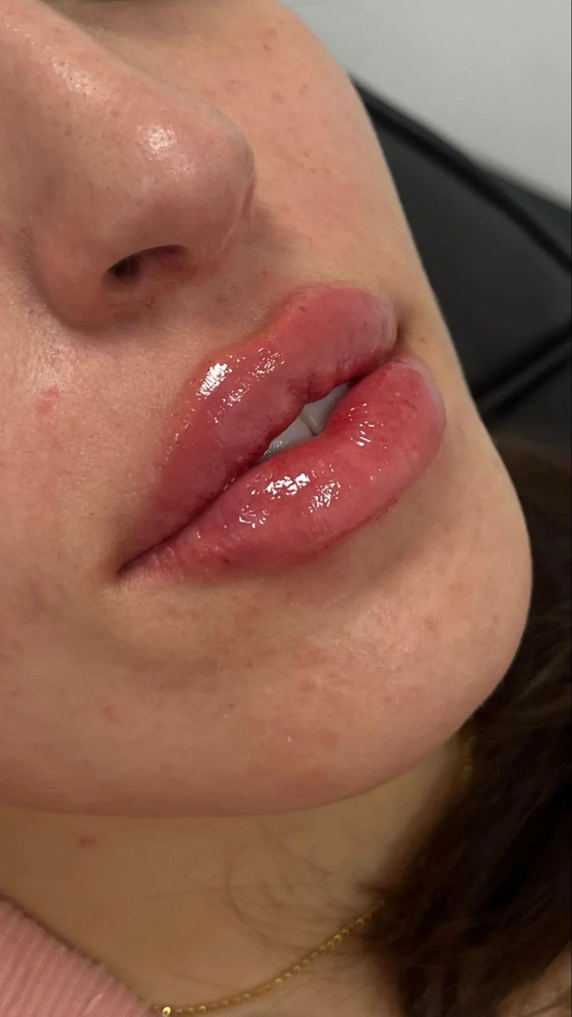 Preenchimento Labial