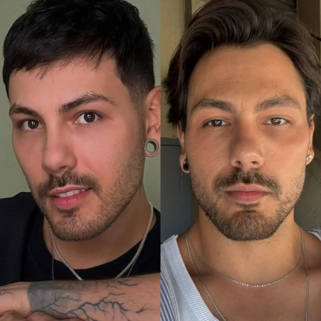 Preenchimento Mandíbula