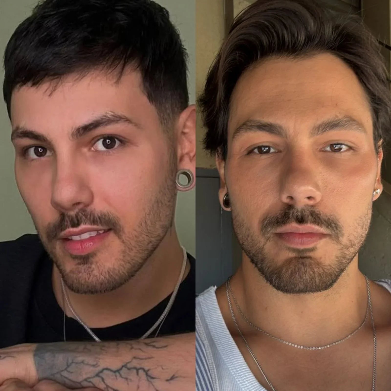 Preenchimento Mandíbula