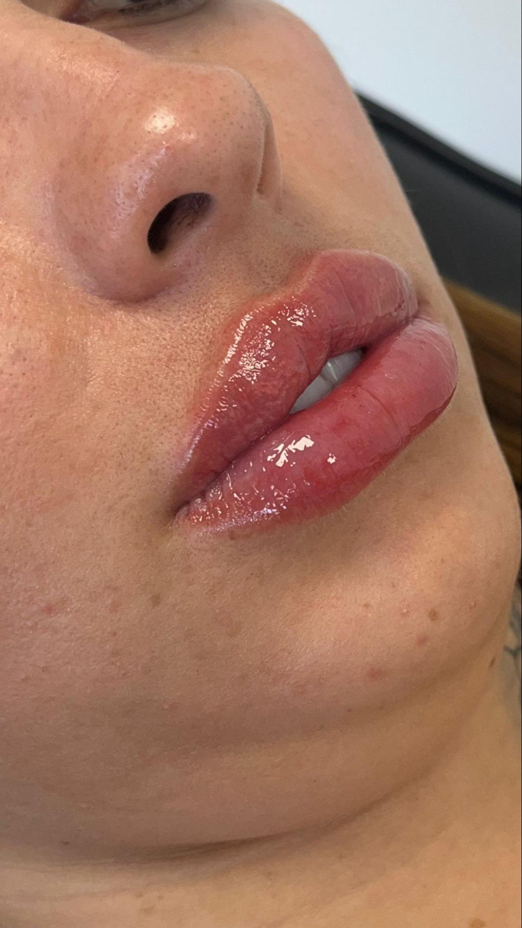 Preenchimento Labial