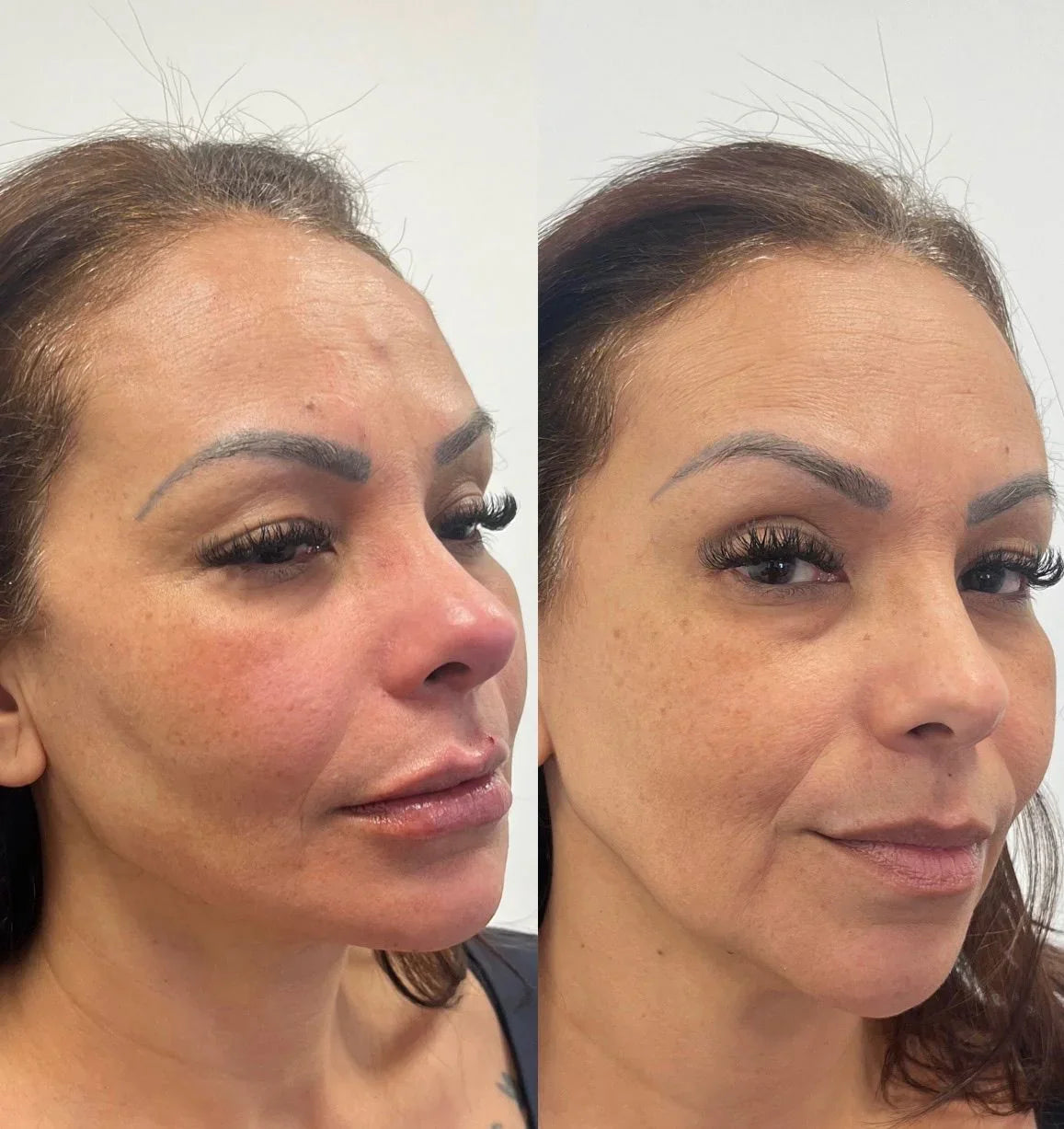 Preenchimento Pré-Jowls