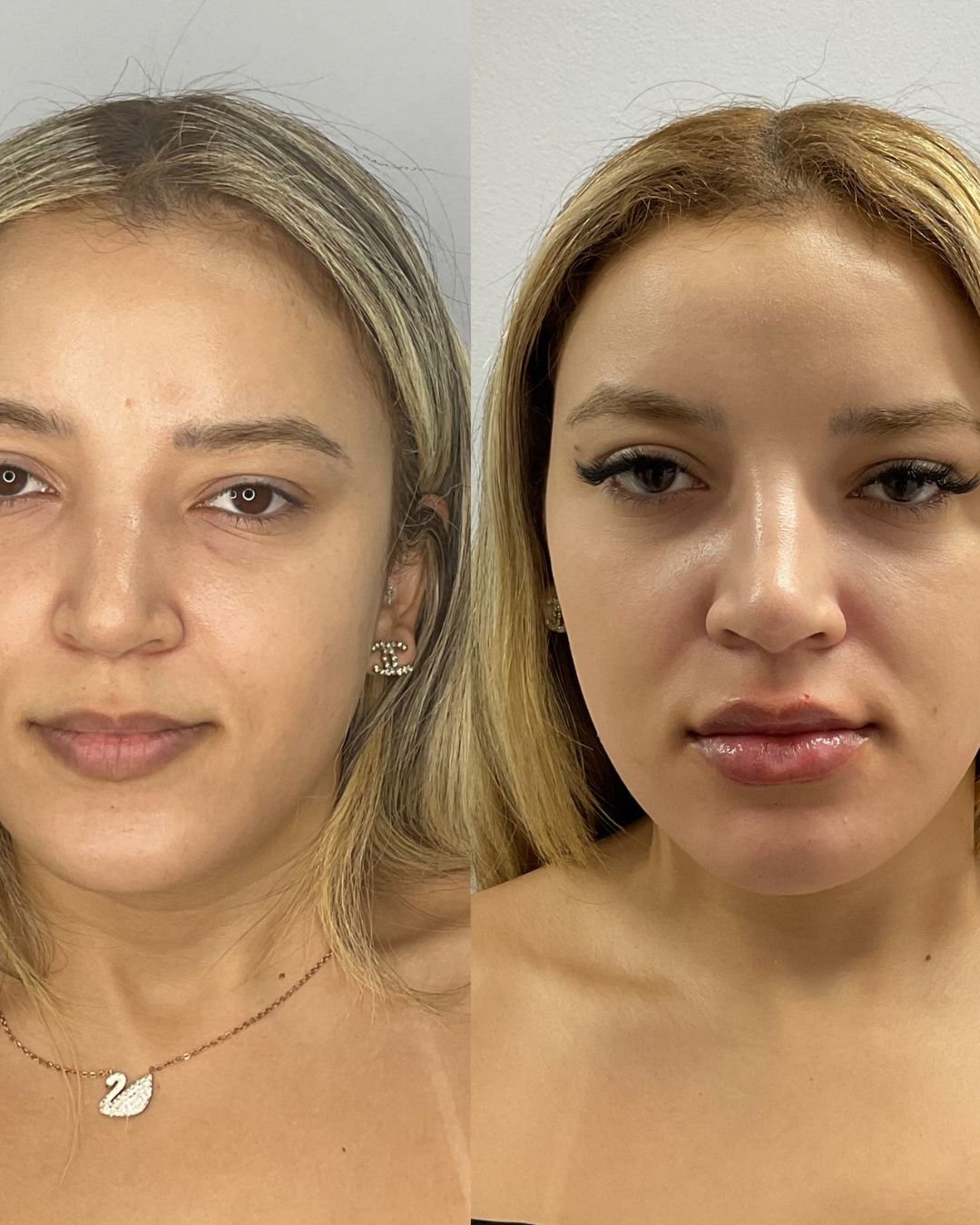 Preenchimento de olheira