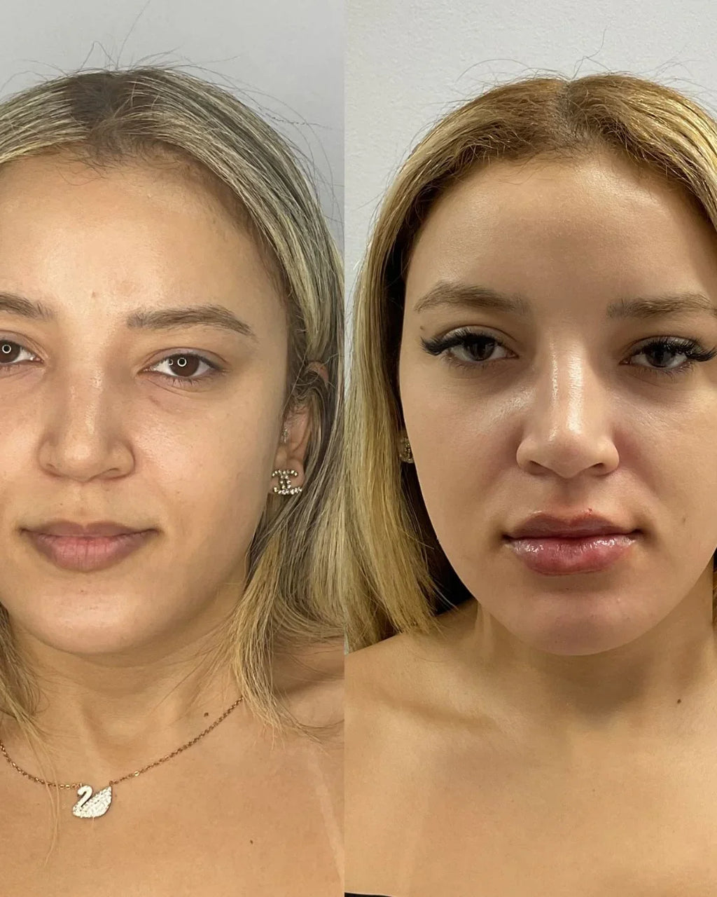 Preenchimento de olheira