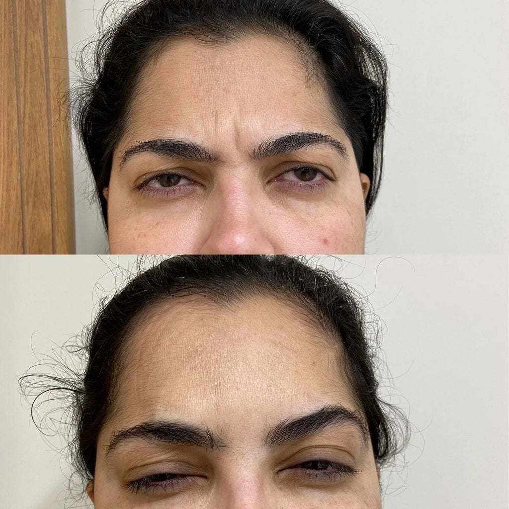 Botox 50 UI (unidades internacionais)