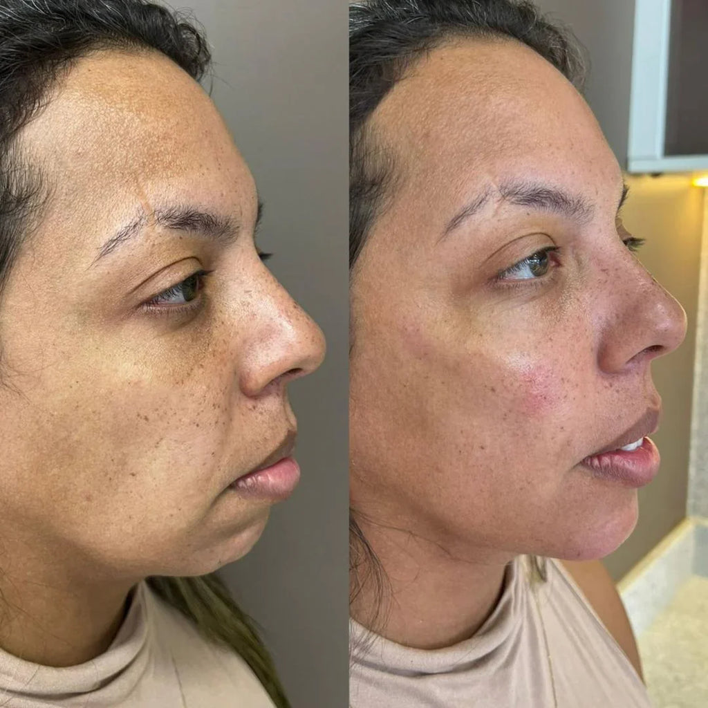Preenchimento Pré-Jowls